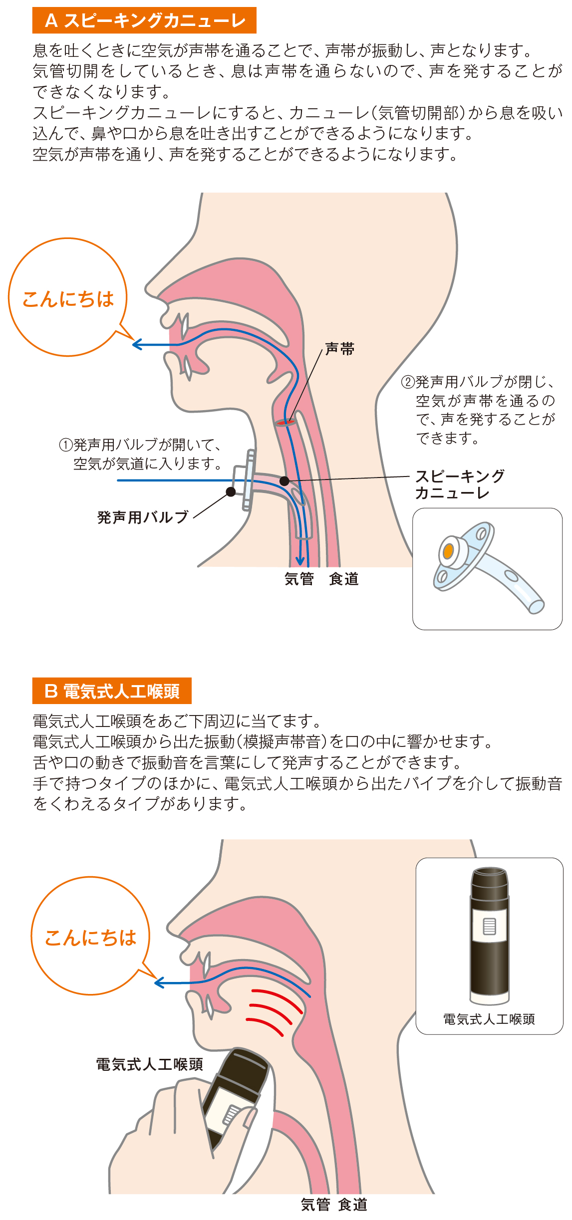 図4:スピーキングカニューレと電気式人工喉頭