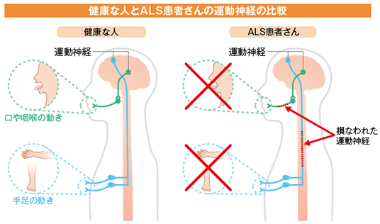  ALSの症状は神経損傷に似ていますか?
